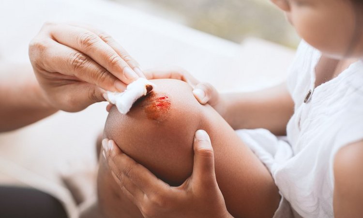 Eine offene Wunde am Knie eines Kindes wird mit einem Tupfer gesäubert
